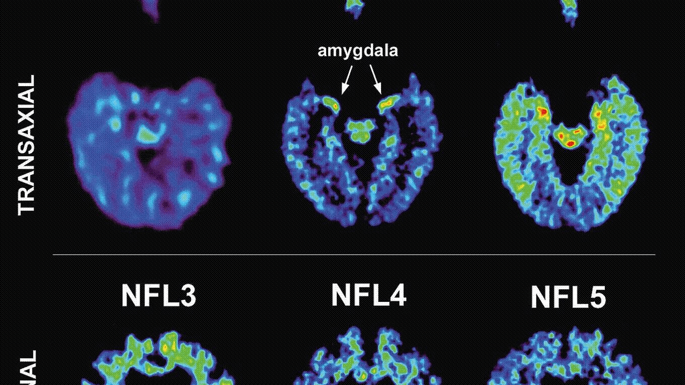 Source: CNN - Results of Dr. Gary Small’s brain study in Semel Institute for Neuroscience and Human Behavior at UCLA